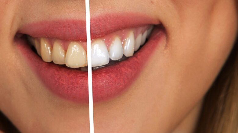 Proper Tooth Brushing, Teeth Stains,, How to get Instant Pain Relief For Toothaches