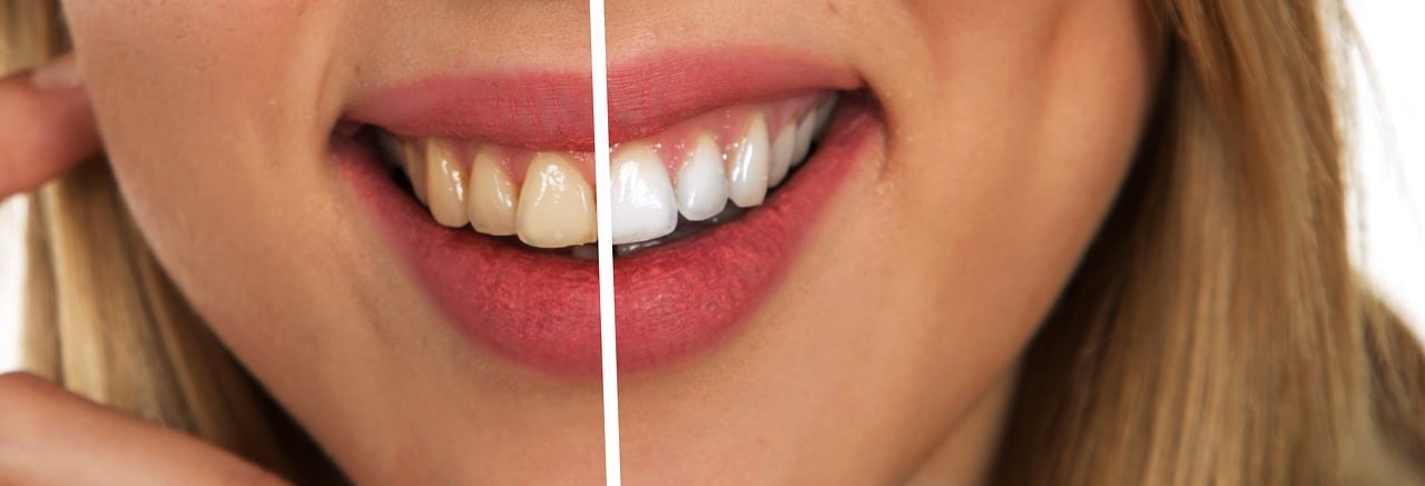 Proper Tooth Brushing, Teeth Stains,, How to get Instant Pain Relief For Toothaches