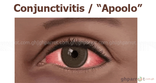 CONJUNCTIVITIS, What is conjunctivitis,