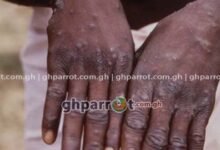 MPOX, GHANA HEALTH SERVICE, MPOX CASES IN GHANA,