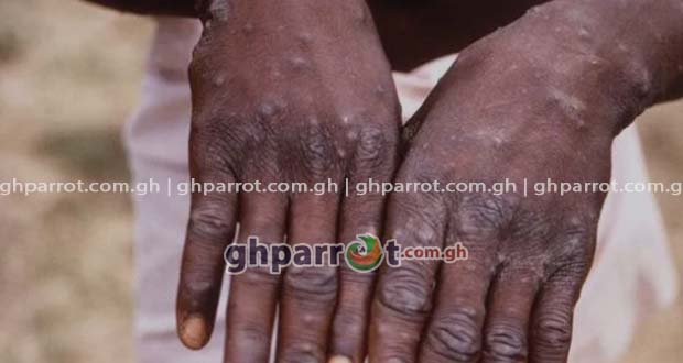 MPOX, GHANA HEALTH SERVICE, MPOX CASES IN GHANA,