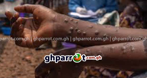 mpox,